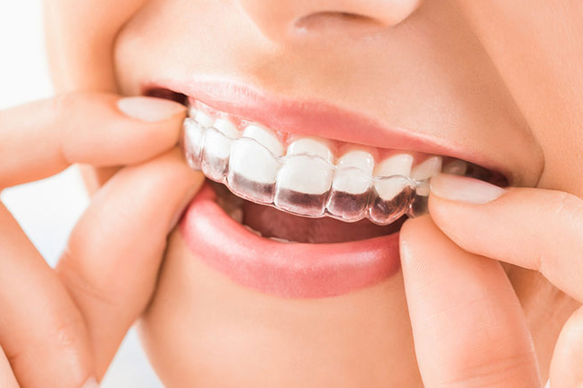 Invisible Braces
