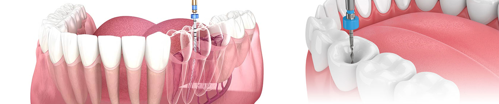 Dental Procedure