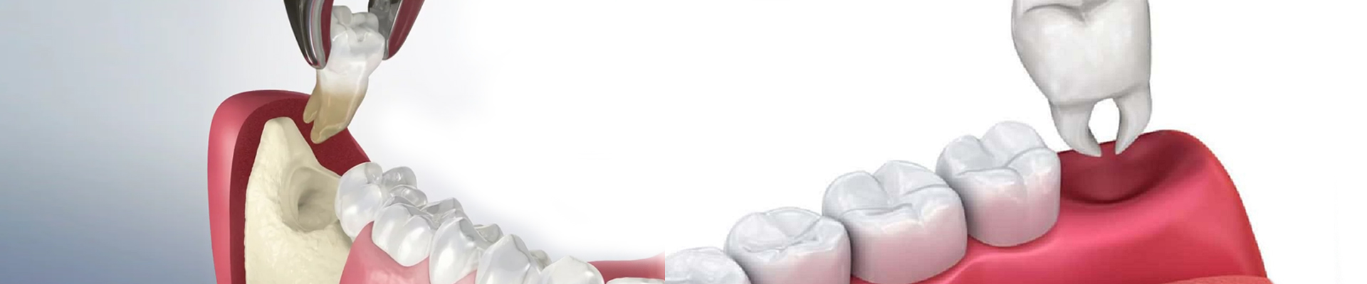 Tooth removal