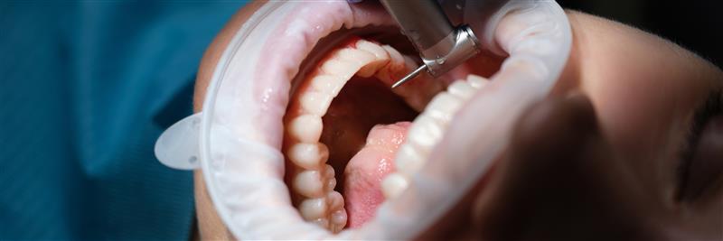 Painless Root Canal in Warangal