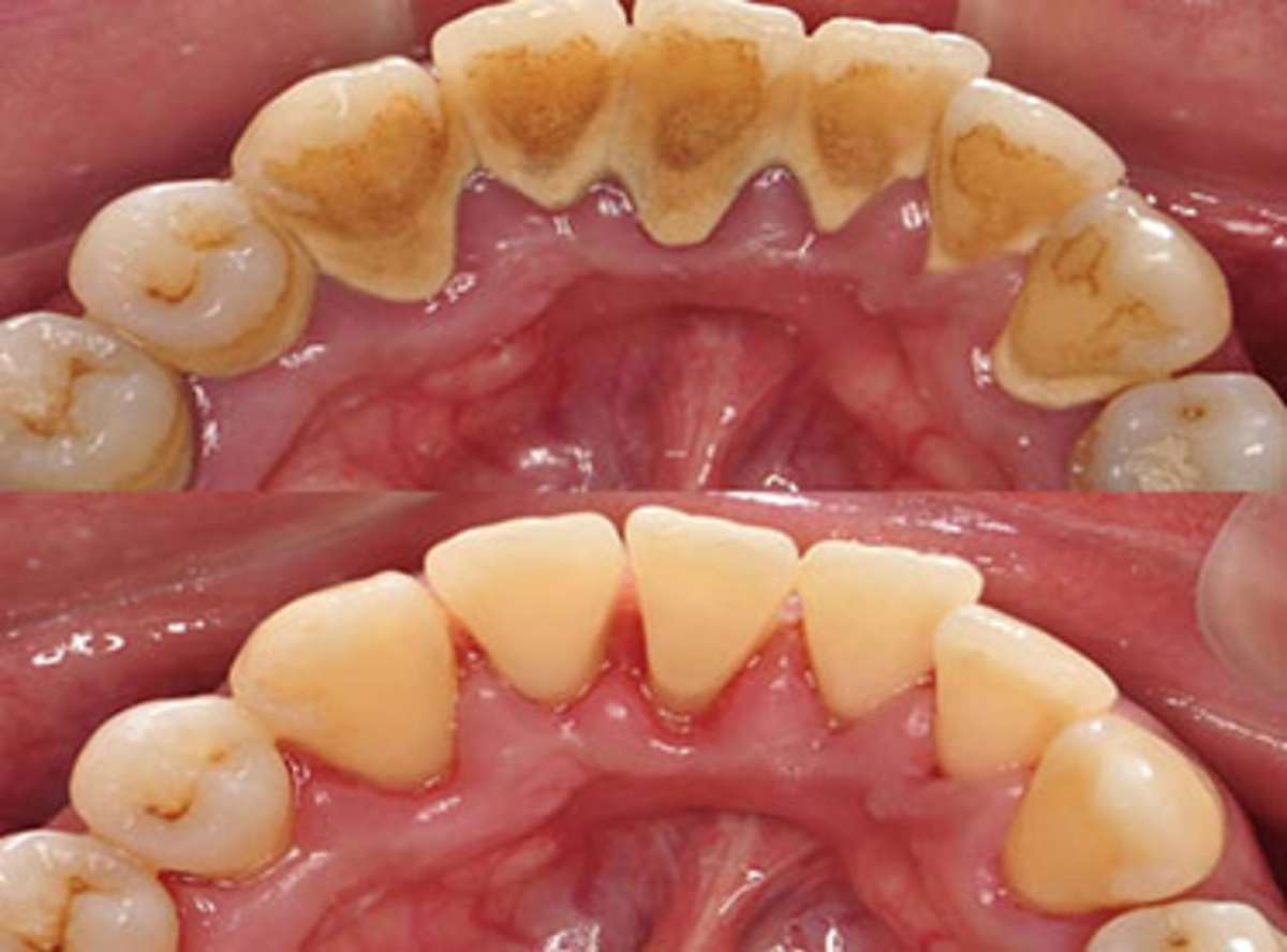 Advantages of Laser in Dentistry