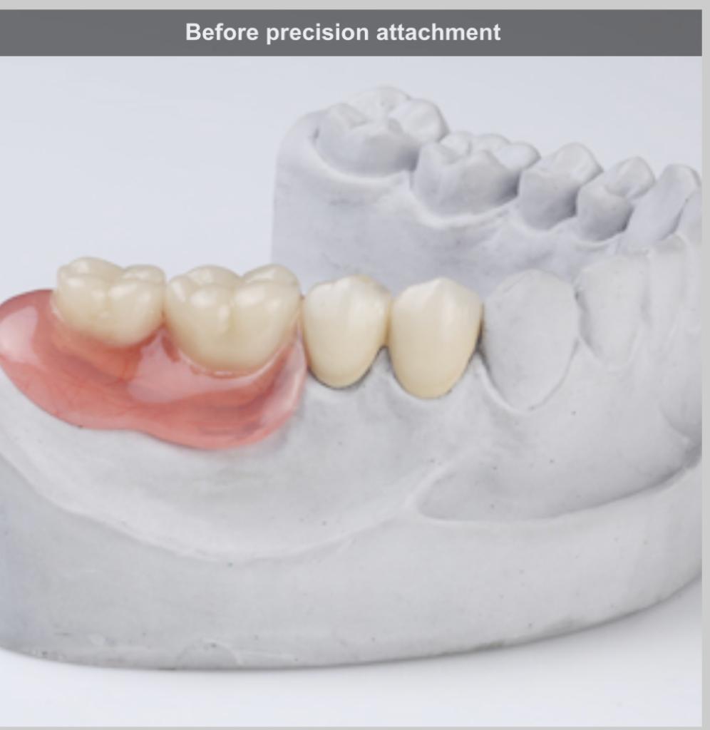 Before Precision Attachment