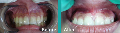 Frenectomy