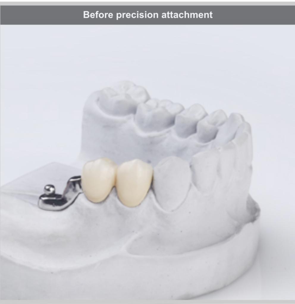 Implant Preparation