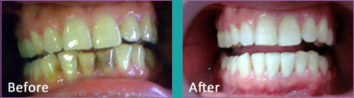 Laser Teeth Whitening