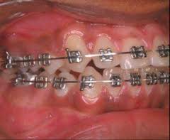 Metal Braces
