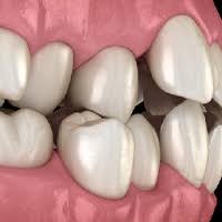 Teeth misalignment