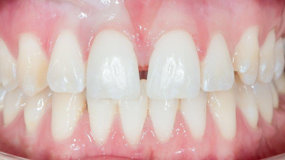 Tooth exposure