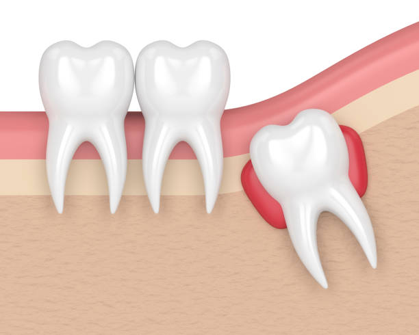 Tooth inflammation