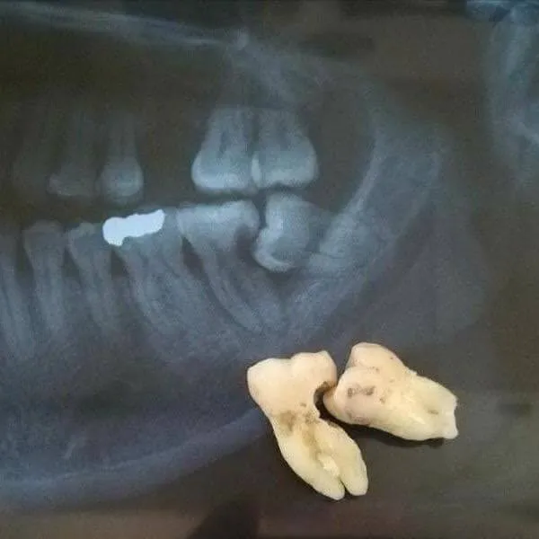 Wisdom tooth cavity infection