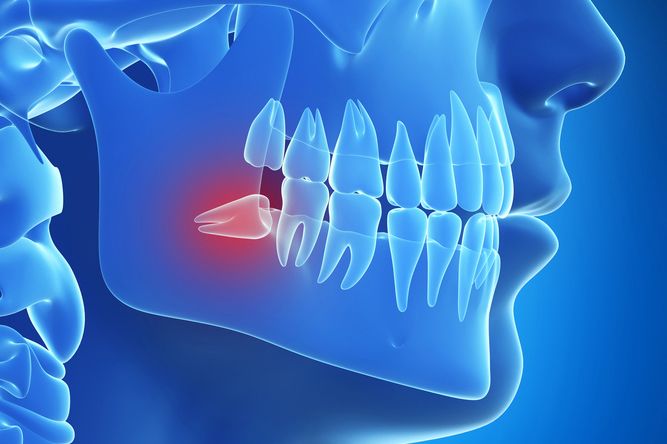 Wisdom tooth removal treatment