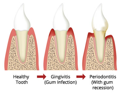 Gum Treatment – Protecting Teeth in Hanamkonda